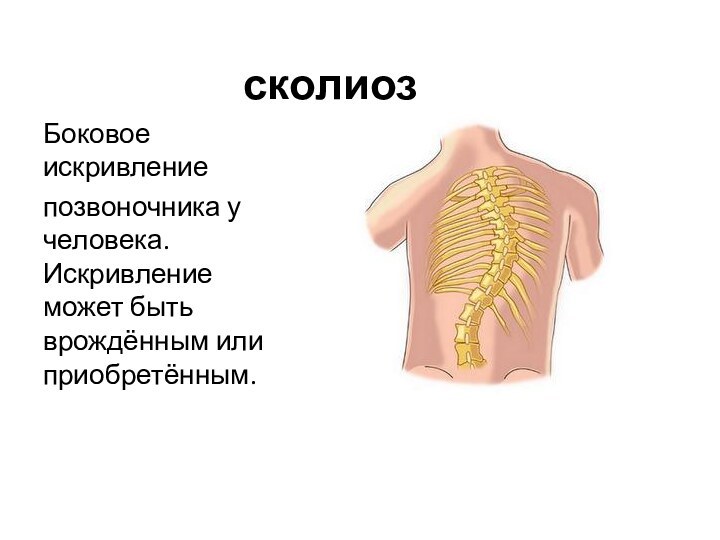 сколиозБоковое искривление позвоночника у человека. Искривление может быть врождённым или приобретённым.