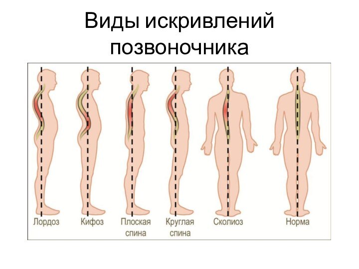 Виды искривлений позвоночника