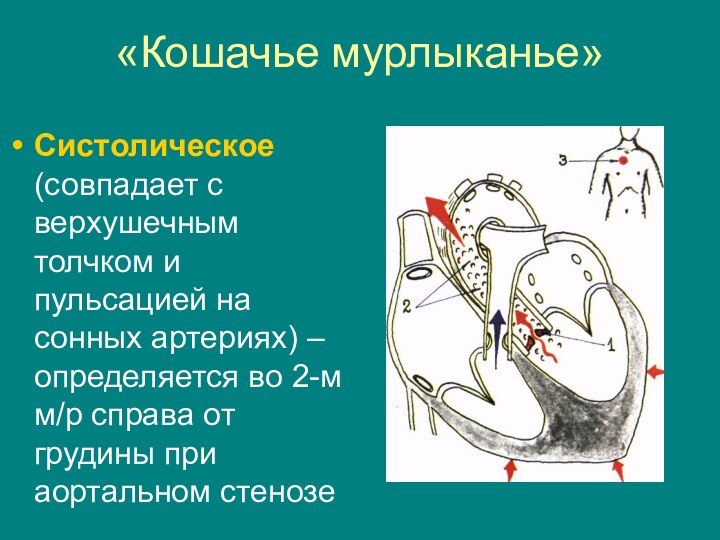 «Кошачье мурлыканье»Систолическое (совпадает с верхушечным толчком и пульсацией на сонных артериях) –