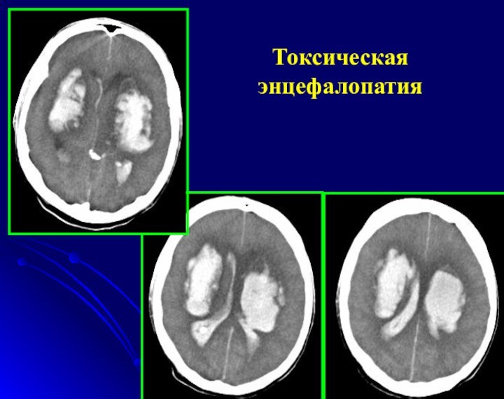 Токсическая энцефалопатия