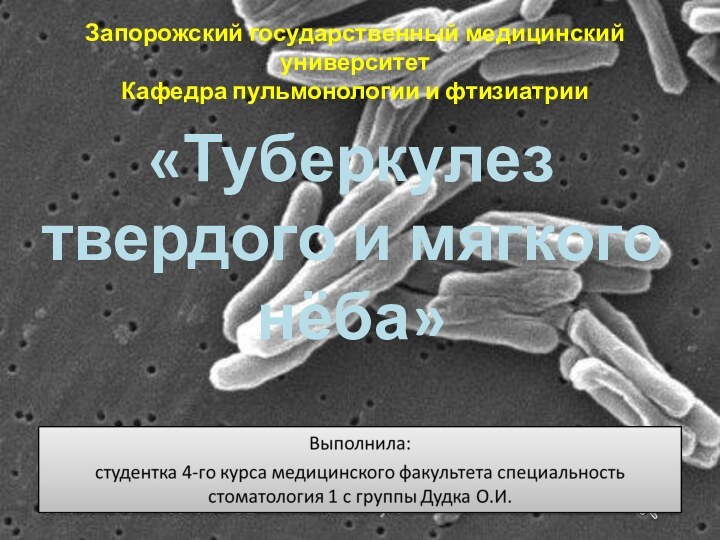 «Туберкулез твердого и мягкого нёба»Запорожский государственный медицинский университетКафедра пульмонологии и фтизиатрии