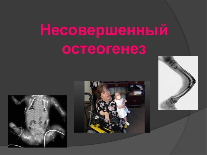 Несовершенный остеогенез