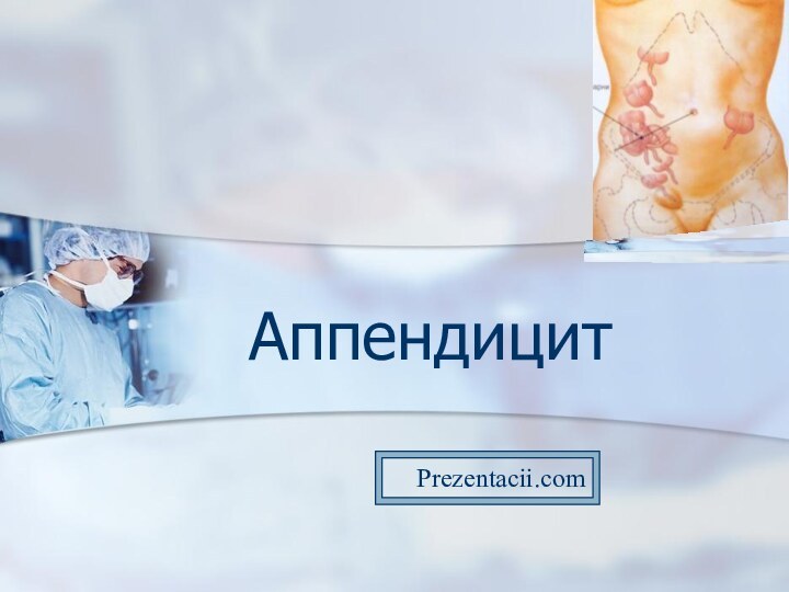 АппендицитPrezentacii.com