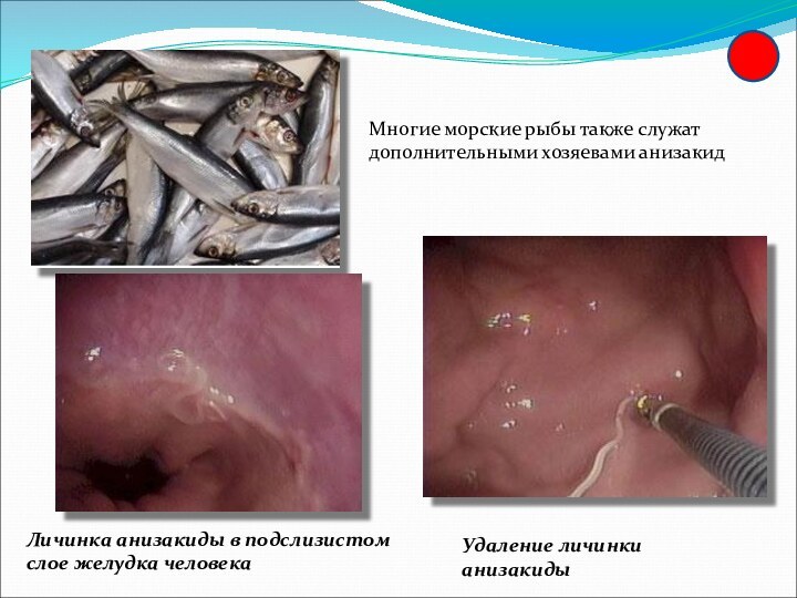 Многие морские рыбы также служат дополнительными хозяевами анизакидЛичинка анизакиды в подслизистом слое