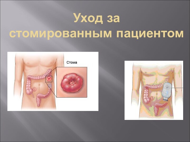 Уход за  стомированным пациентом