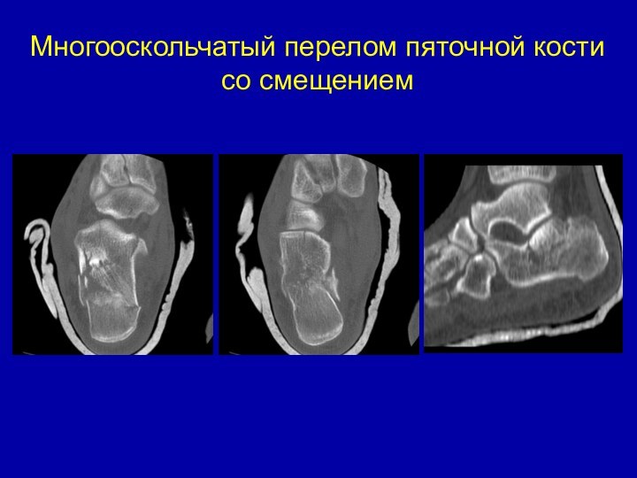 Многооскольчатый перелом пяточной кости со смещением