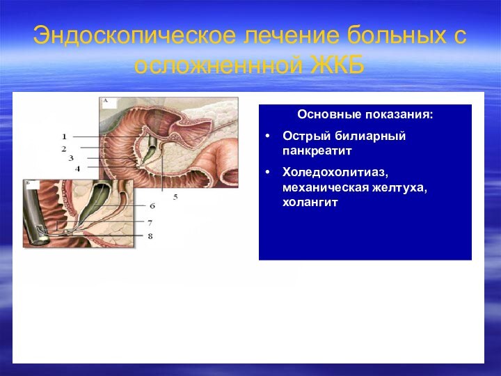 Эндоскопическое лечение больных с осложненнной ЖКБОсновные показания:Острый билиарный панкреатитХоледохолитиаз, механическая желтуха, холангит