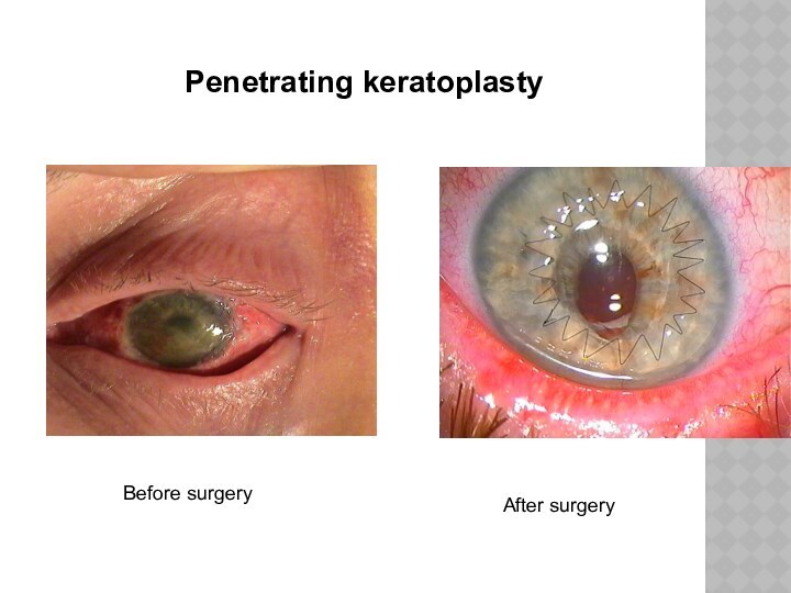 Penetrating keratoplastyBefore surgeryAfter surgery