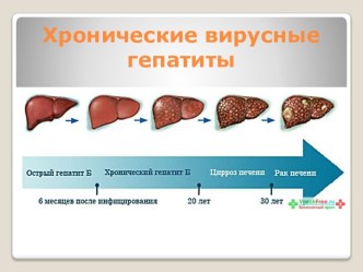 Хронические вирусные гепатиты