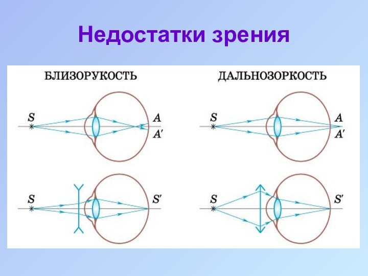 Недостатки зрения