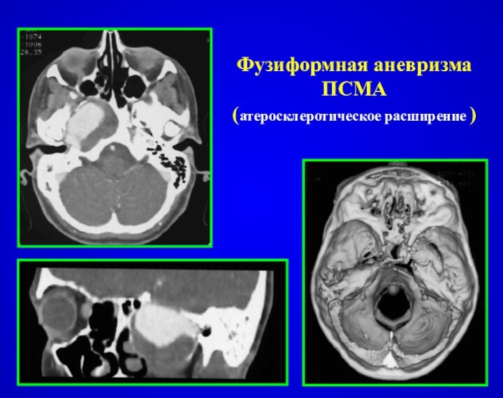 Фузиформная аневризма ПСМА (атеросклеротическое расширение )