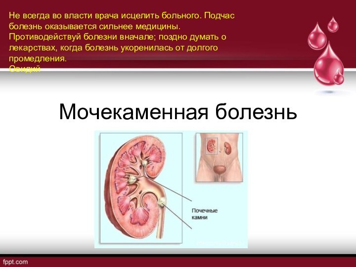 Мочекаменная болезньНе всегда во власти врача исцелить больного. Подчас болезнь оказывается сильнее