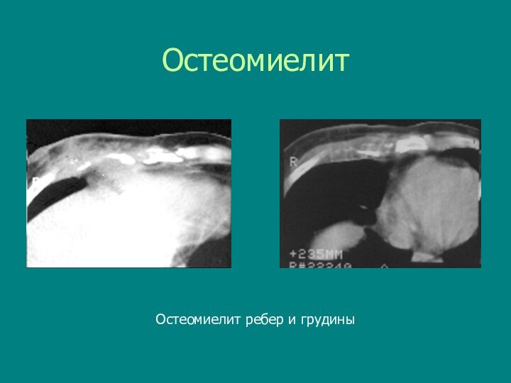 ОстеомиелитОстеомиелит ребер и грудины