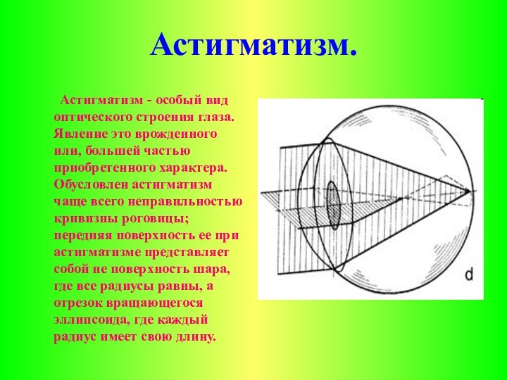 Астигматизм.	Астигматизм - особый вид оптического строения глаза. Явление это врожденного или, большей