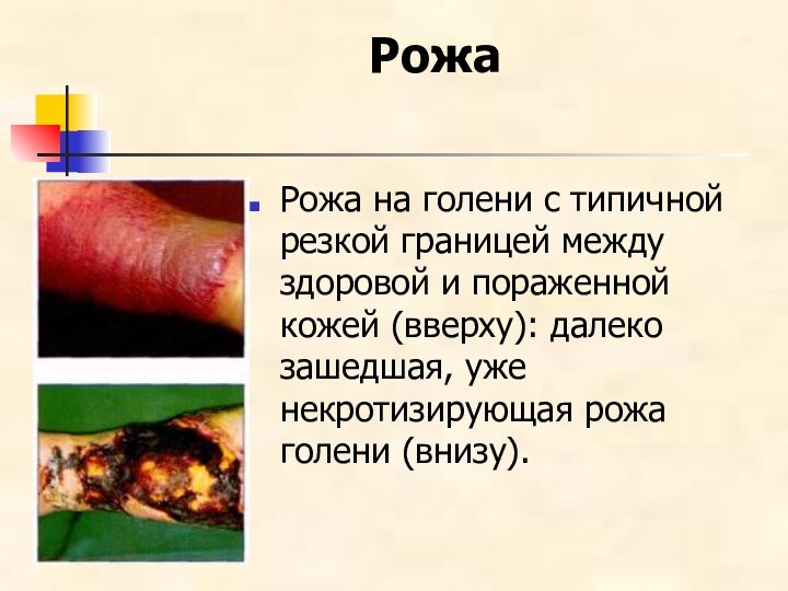 Рожа  Рожа на голени с типичной резкой границей между здоровой и