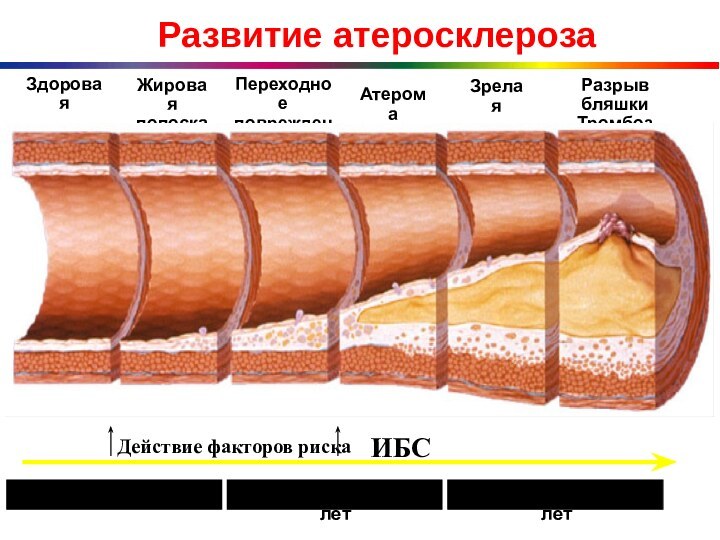 Развитие атеросклерозаЗдоровая артерияЖировая полоскаПереходноеповреждениеАтеромаЗрелая бляшкаРазрыв бляшкиТромбозС первых десятилетий жизниС 30 летС 40 летИБСДействие факторов риска