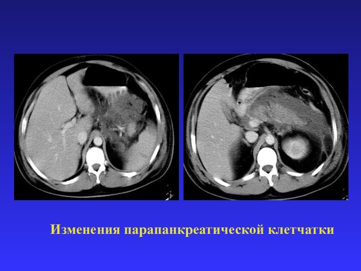 Изменения парапанкреатической клетчатки