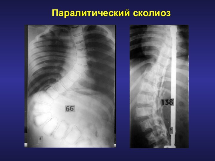 Паралитический сколиоз