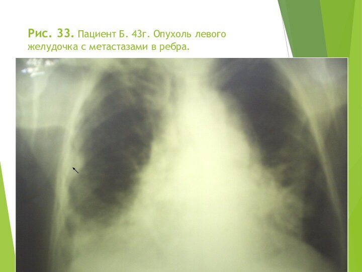 Рис. 33. Пациент Б. 43г. Опухоль левого желудочка с метастазами в ребра.Н.С. Воротынцева, С.С. Гольев Рентгенопульмонология