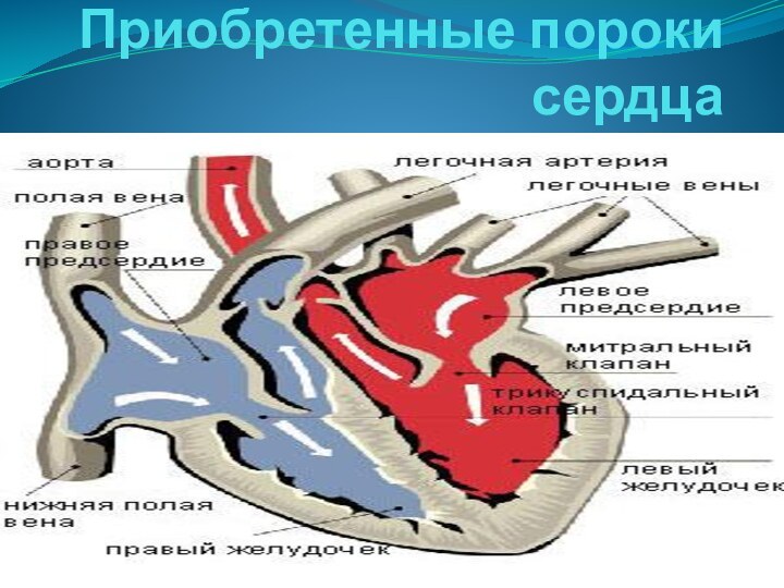 Приобретенные пороки сердца