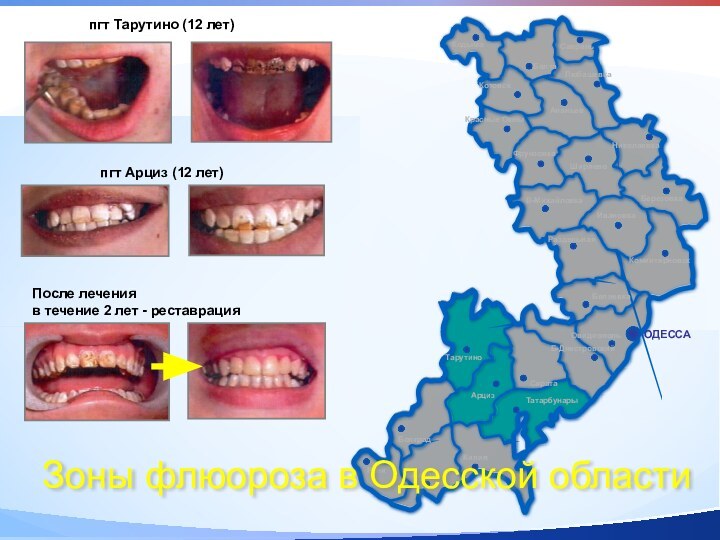 ТатарбунарыТарутиноАрцизЗоны флюороза в Одесской областипгт Тарутино (12 лет)пгт Арциз (12 лет)После лечения