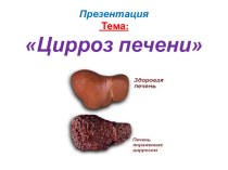 Цирроз печени