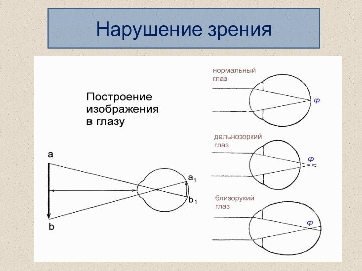 Нарушение зрения