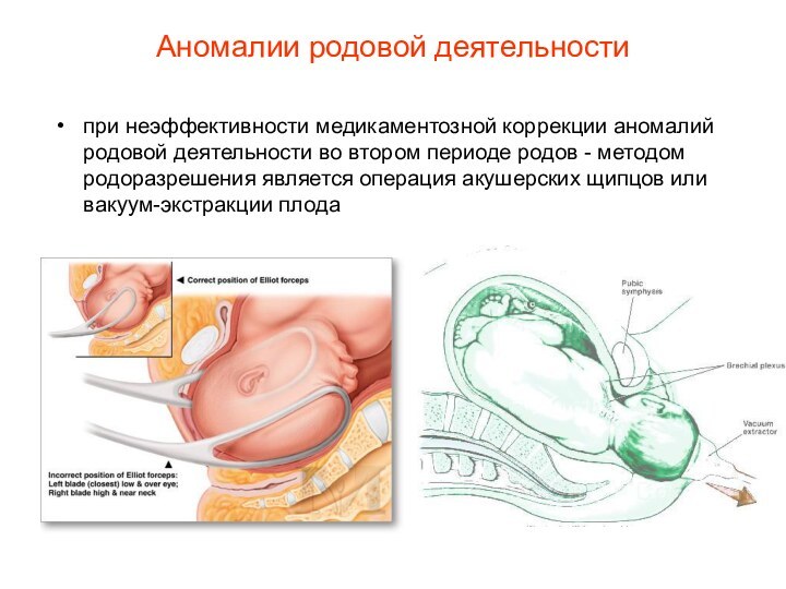 Аномалии родовой деятельностипри неэффективности медикаментозной коррекции аномалий родовой деятельности во втором периоде