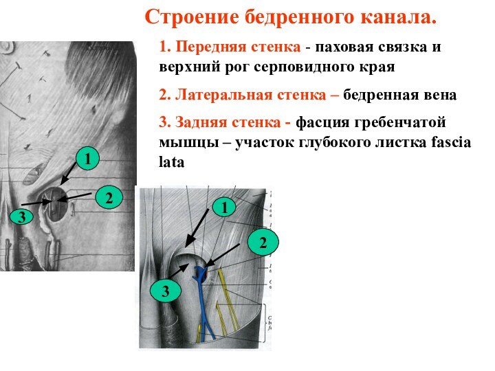 Строение бедренного канала.1. Передняя стенка - паховая связка и верхний рог серповидного