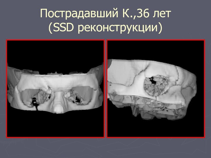 Пострадавший К.,36 лет  (SSD реконструкции)