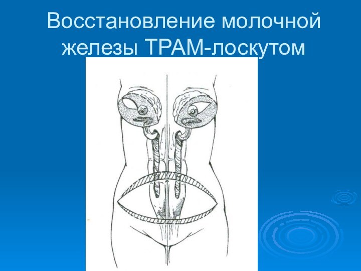 Восстановление молочной железы ТРАМ-лоскутом