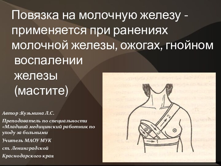 Повязка на молочную железу - применяется при ранениях молочной железы, ожогах, гнойном