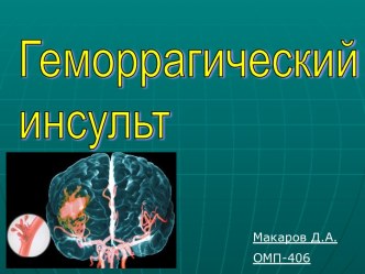 Геморрагический инсульт