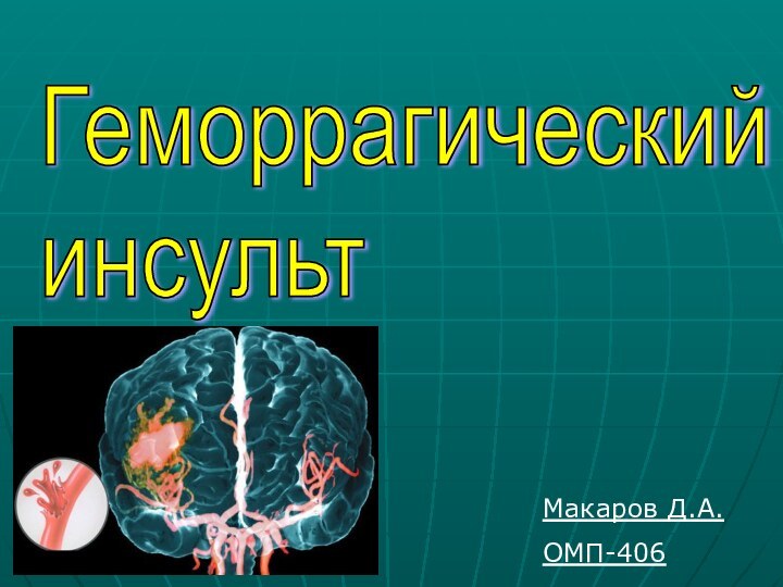 Геморрагический  инсультМакаров Д.А.ОМП-406