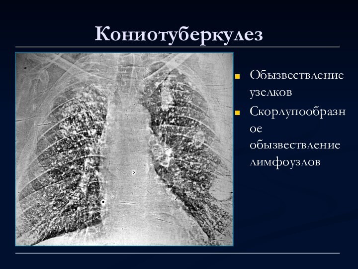 КониотуберкулезОбызвествление узелковСкорлупообразное обызвествление лимфоузлов