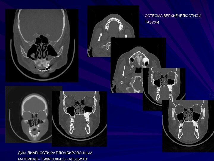 ОСТЕОМА ВЕРХНЕЧЕЛЮСТНОЙ ПАЗУХИДИФ. ДИАГНОСТИКА: ПЛОМБИРОВОЧНЫЙ МАТЕРИАЛ – ГИДРООКИСЬ КАЛЬЦИЯ В ПАЗУХЕ……..ОСТЕОМА?