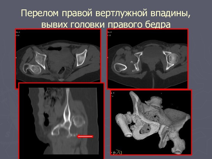 Перелом правой вертлужной впадины, вывих головки правого бедра