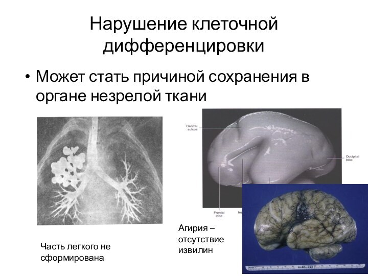 Нарушение клеточной дифференцировкиМожет стать причиной сохранения в органе незрелой тканиЧасть легкого не сформированаАгирия – отсутствие извилин