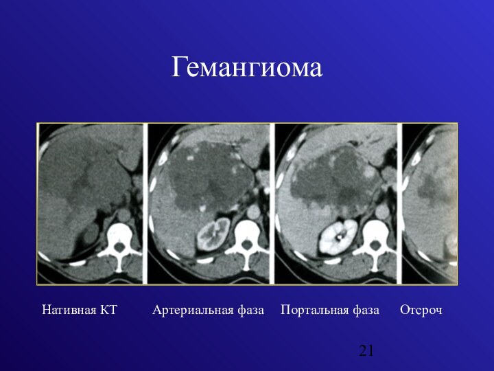 Гемангиомы в уз изображении характеризуются тест