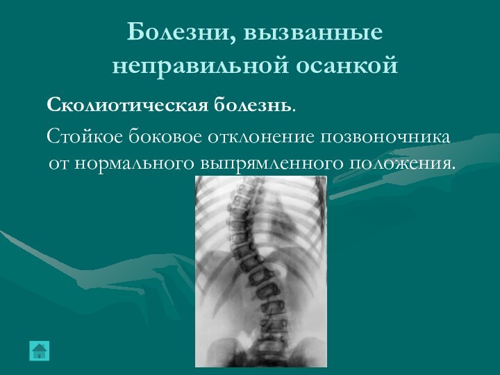 Болезни, вызванные неправильной осанкой  Сколиотическая болезнь.  Стойкое боковое отклонение позвоночника