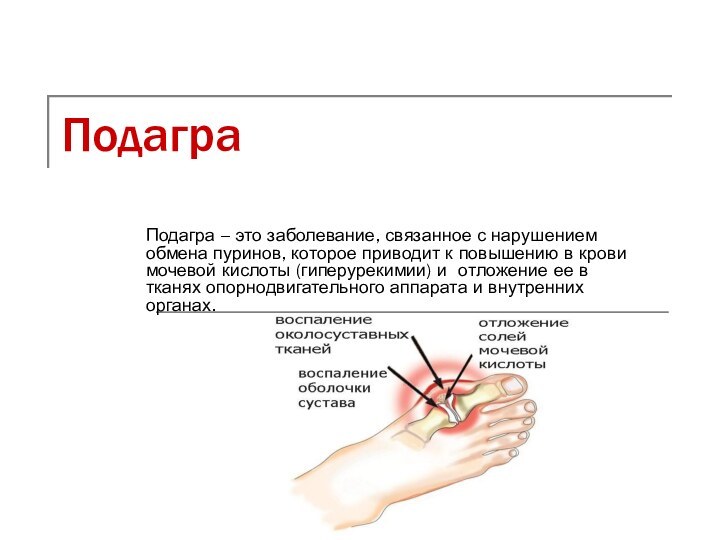 ПодаграПодагра – это заболевание, связанное с нарушением обмена пуринов, которое приводит к