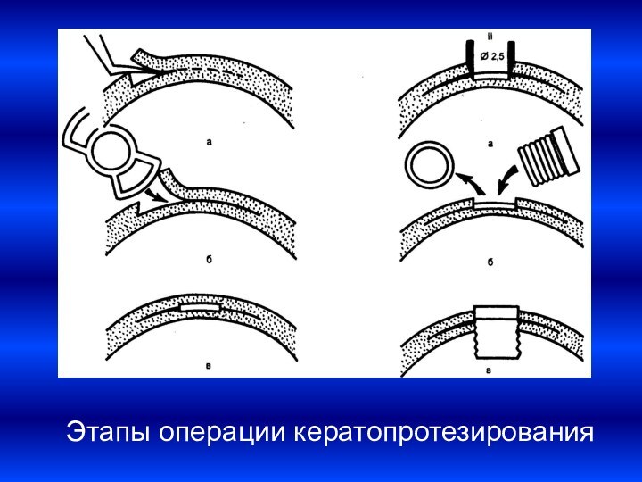 Этапы операции кератопротезирования