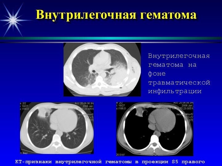 Внутрилегочная гематома  КТ-признаки внутрилегочной гематомы в проекции S5 правого легкогоВнутрилегочнаягематома на фоне травматической инфильтрации