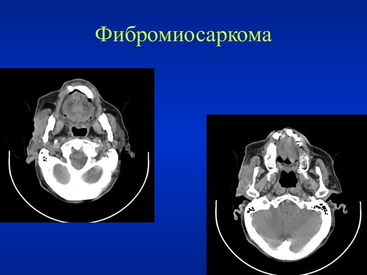 Фибромиосаркома