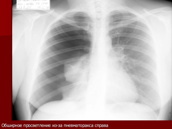 Обширное просветление из-за пневматоракса справа