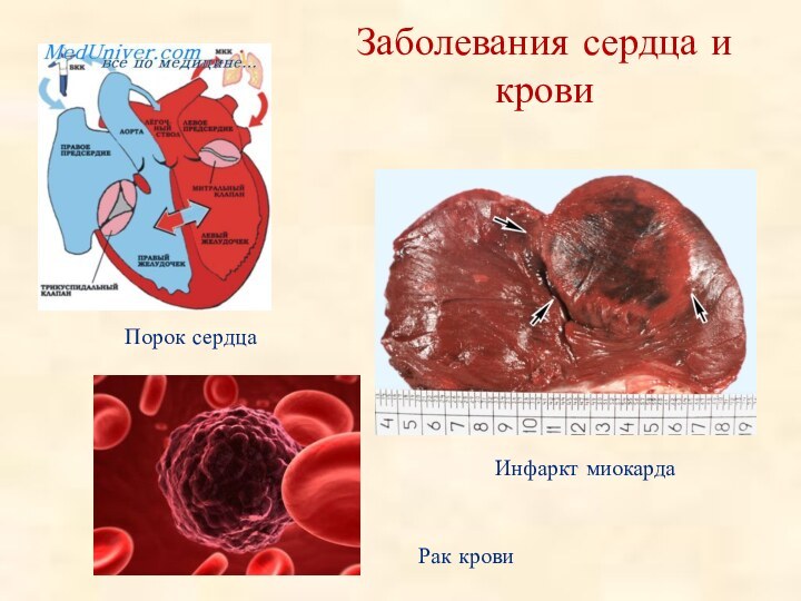 Заболевания сердца и кровиИнфаркт миокардаПорок сердцаРак крови