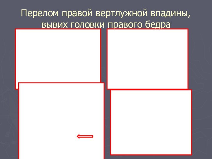 Перелом правой вертлужной впадины, вывих головки правого бедра