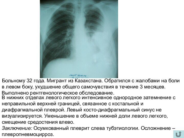 Больному 32 года. Мигрант из Казахстана. Обратился с жалобами на боли в