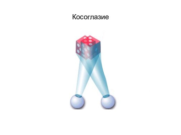 Косоглазие