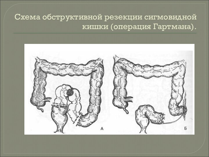 Схема обструктивной резекции сигмовидной кишки (операция Гартмана).